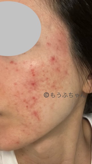 アレルギー反応のようなものが出て荒れている肌