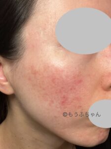 食生活を見直し、肌荒れが落ち着いた画像