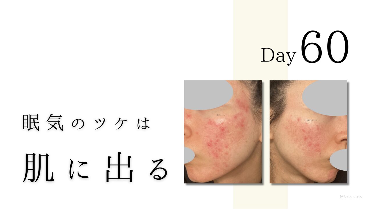 眠気のツケは肌に出る