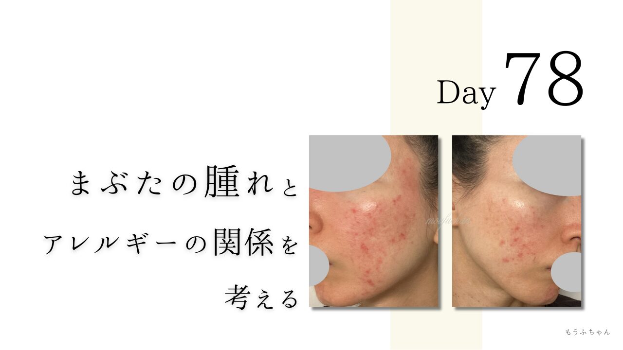 まぶたの腫れとアレルギーの関係を考える