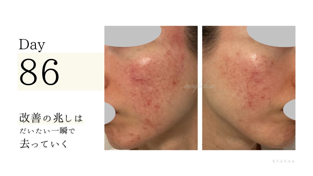 改善の兆しはだいたい一瞬んで去っていく