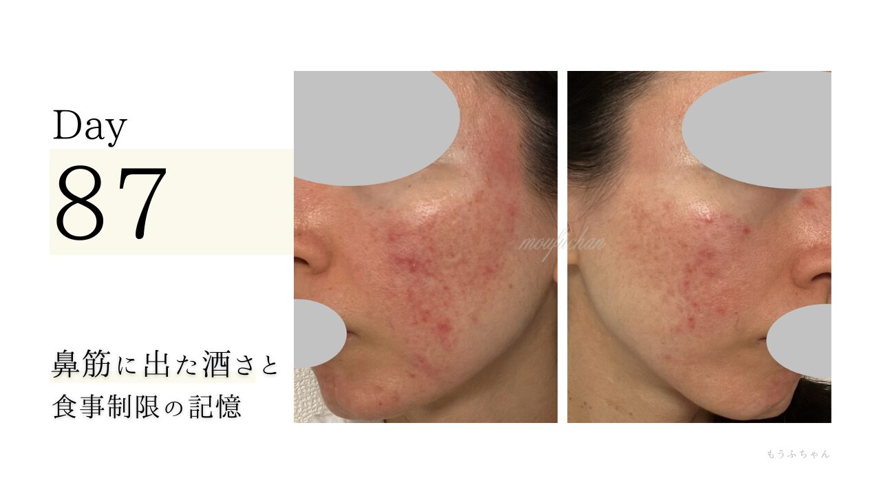 鼻筋に出た酒さと食事制限の記憶