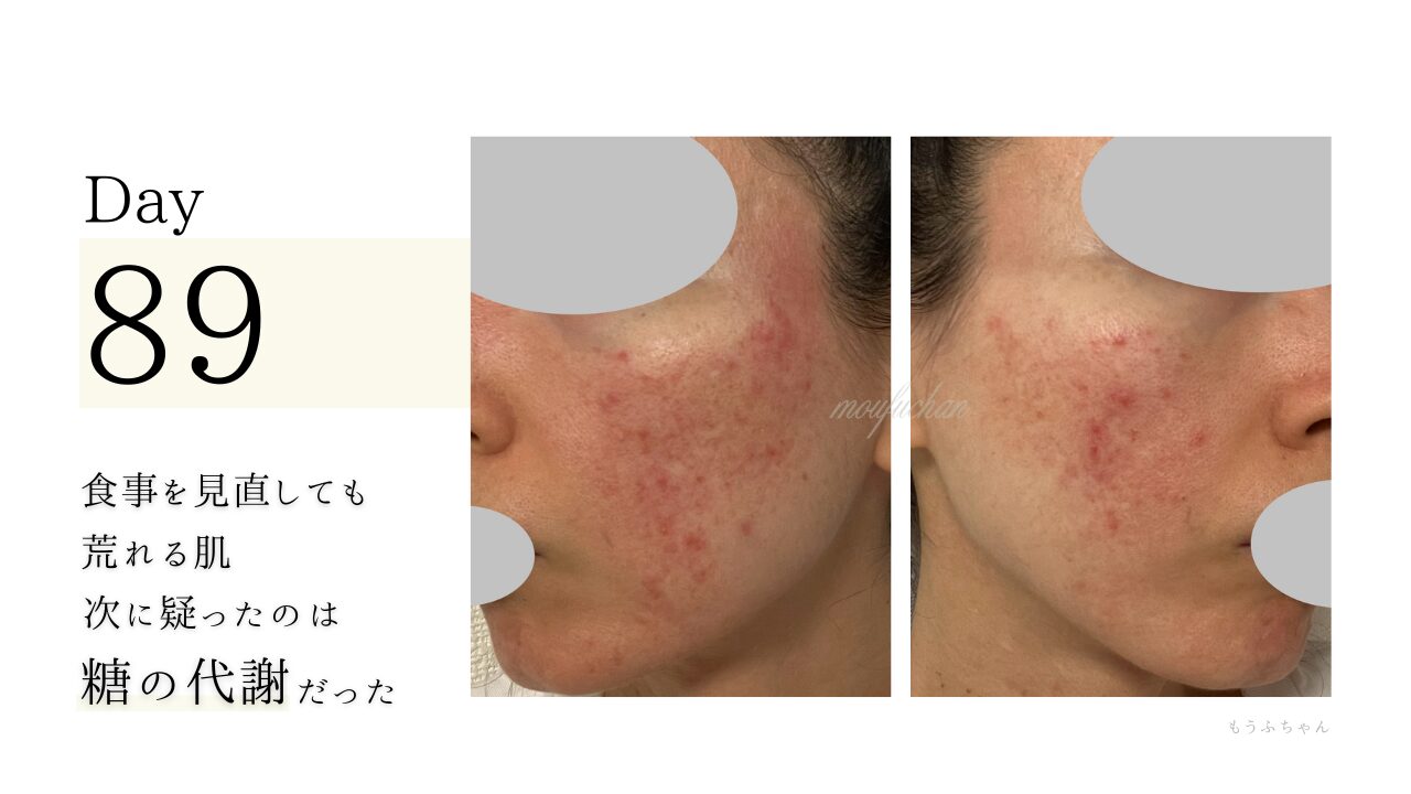 食事を見直しても荒れる肌。 次に疑ったのは、糖の代謝だった。