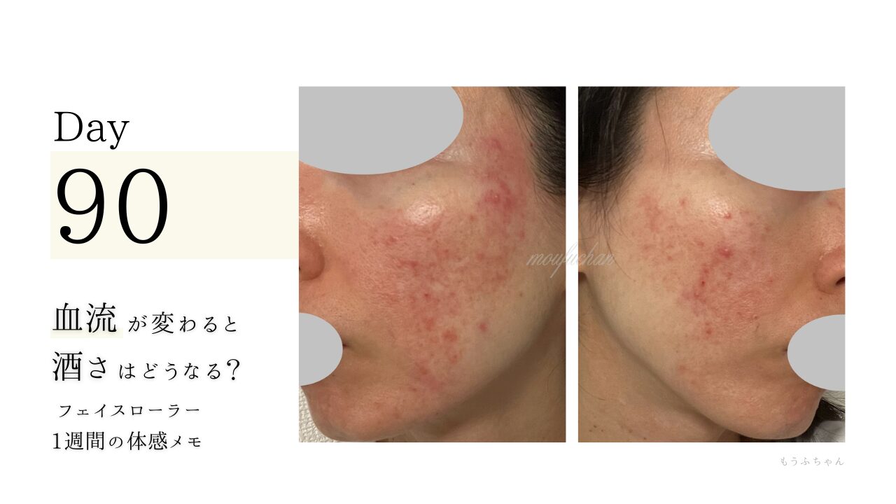 血流が変わると、酒さはどうなる？ フェイスローラー1週間の体感メモ
