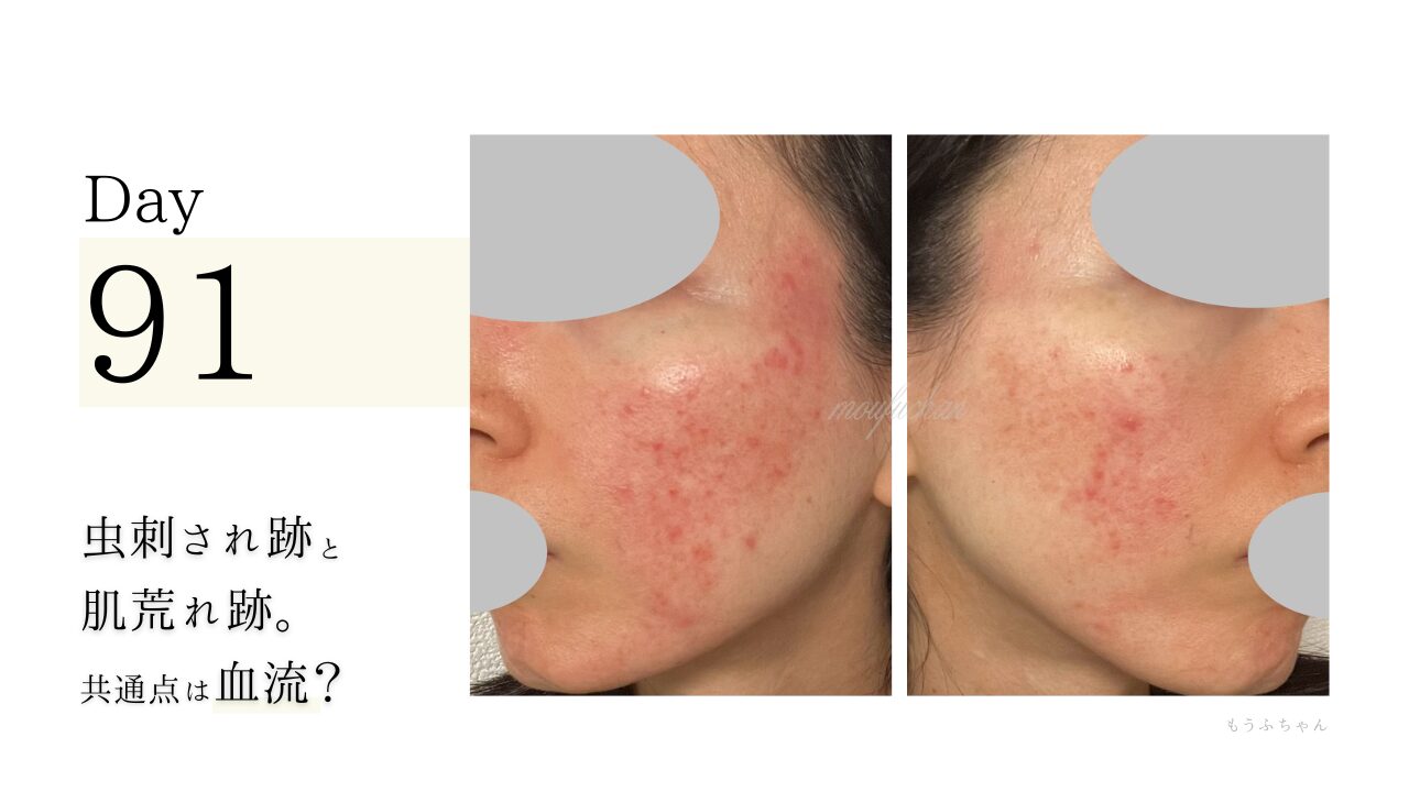 虫刺され跡と肌荒れ跡。 共通点は、血流？